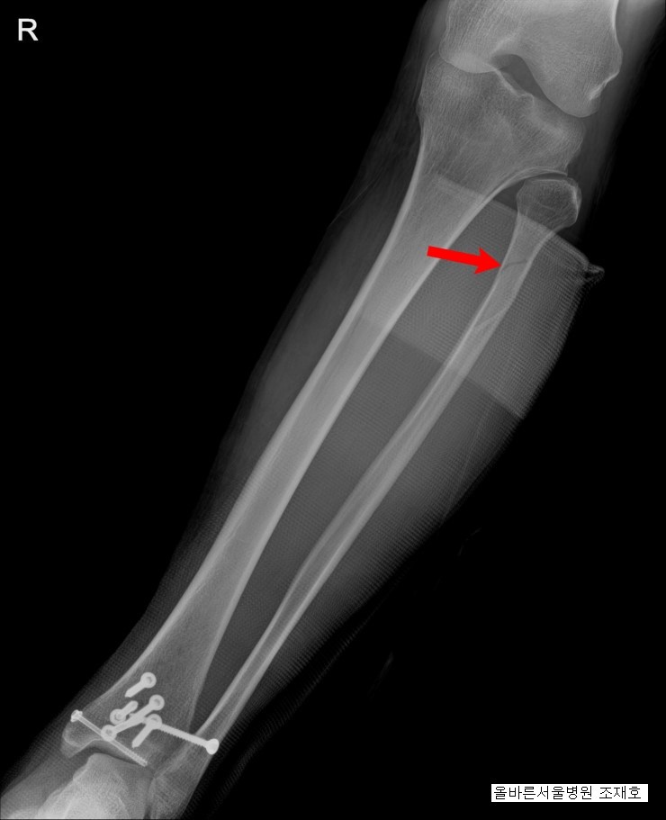 osteocondroza articulațiilor genunchiului 1 grad