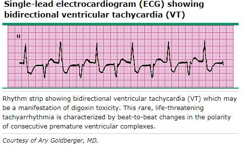digoxin arrhythmia에 대한 이미지 검색결과